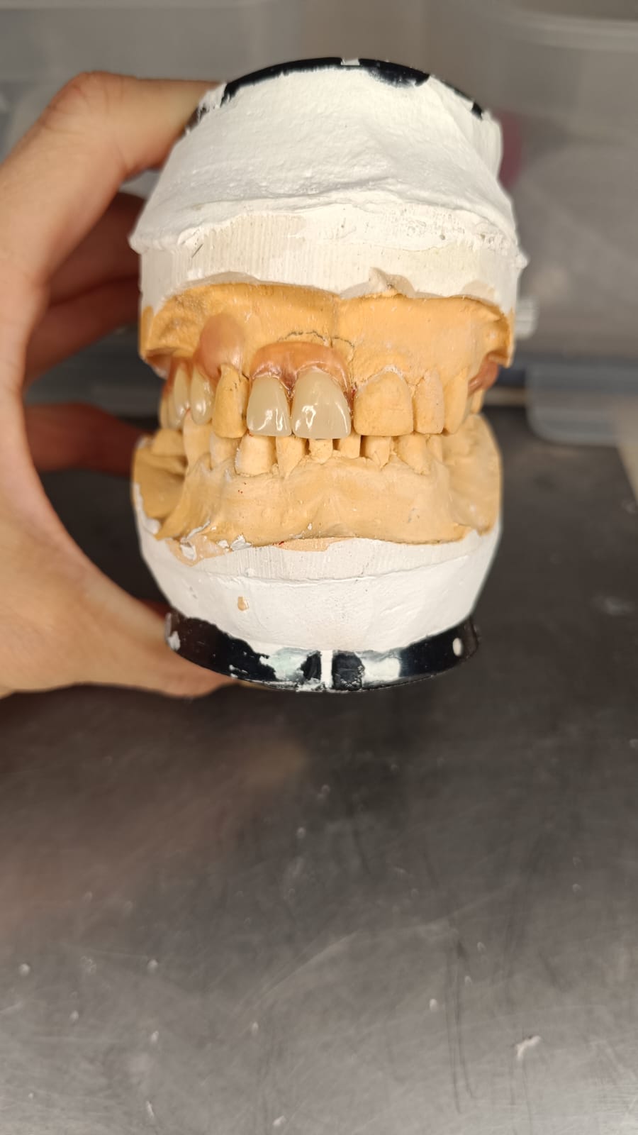 Korony na modelu gipsowym — realizacja Smile Żaneta Skoczko